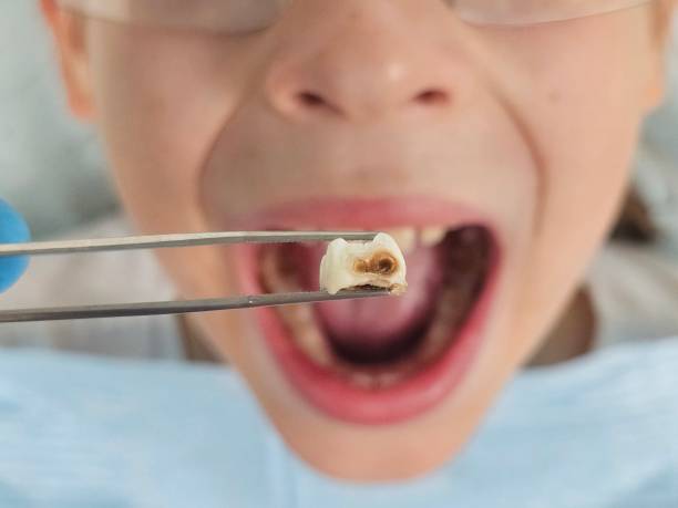 Best Urgent Care for Lost Fillings or Crowns in Lake Mawk, OH